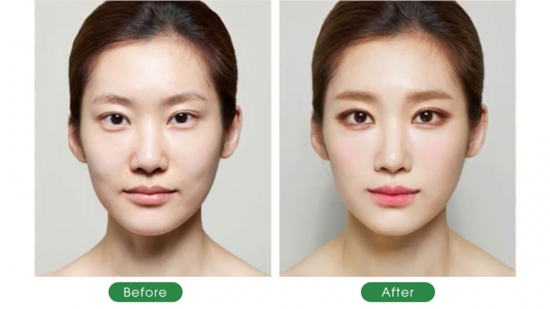 khuôn mặt khách hàng trước và sau khi cấy mỡ baby face