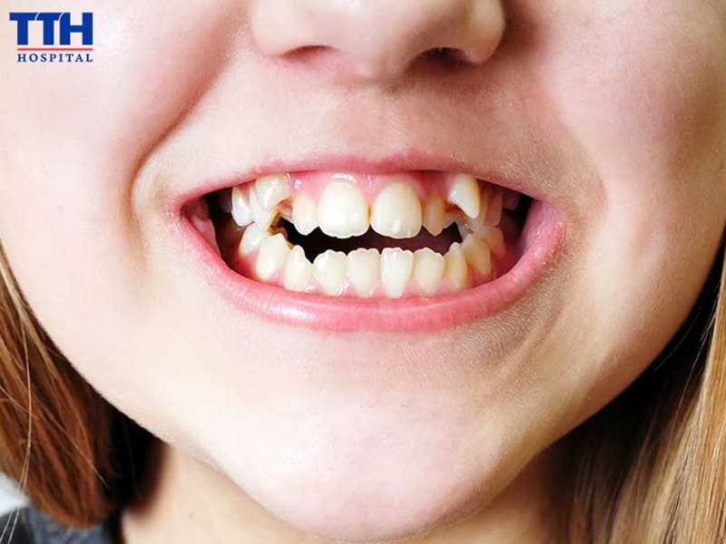 BAO NHIÊU TUỔI LÀ THỜI ĐIỂM LÝ TƯỞNG ĐỂ NIỀNG RĂNG?
