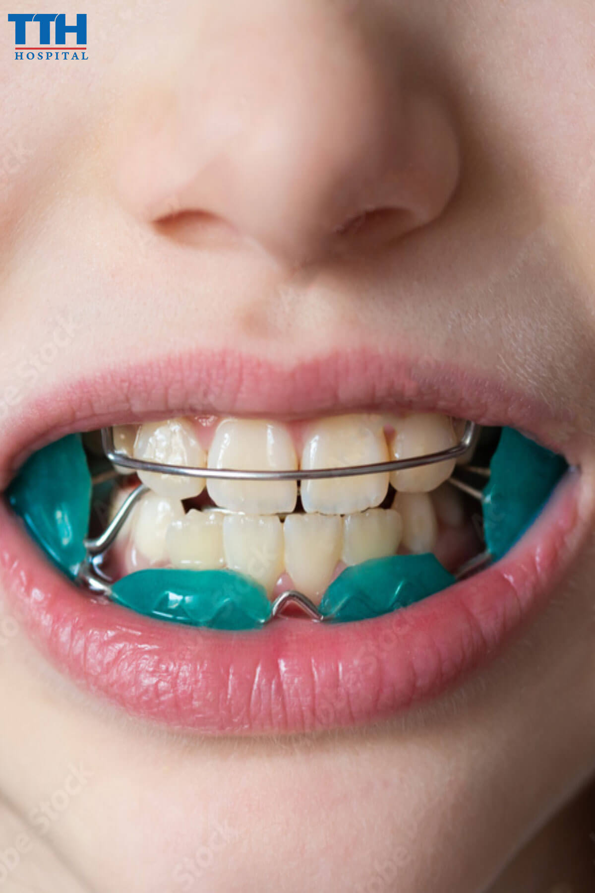 Bị móm có nên niềng răng tại vinh nghệ an không?
