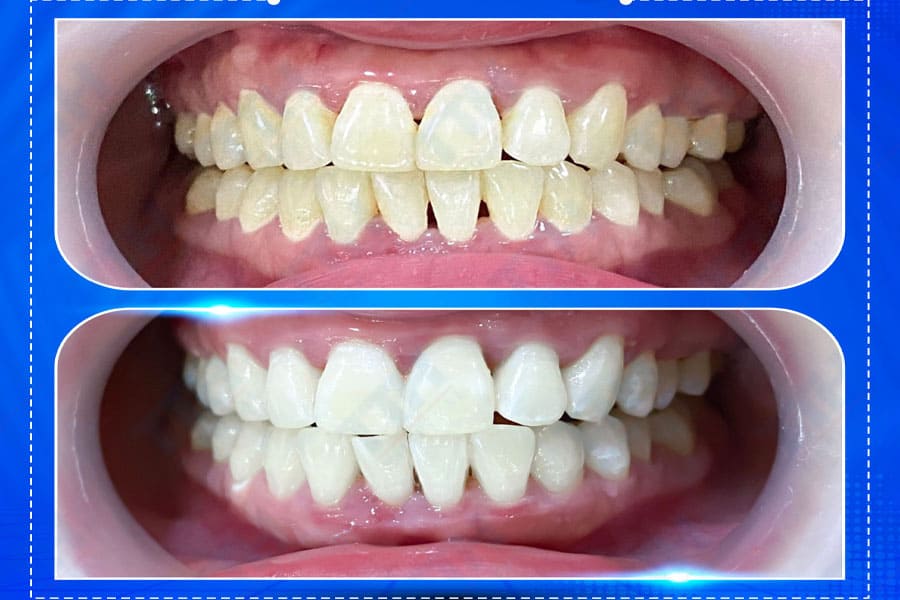 Bí Quyết Duy Trì Răng Trắng Sáng Sau Tẩy
