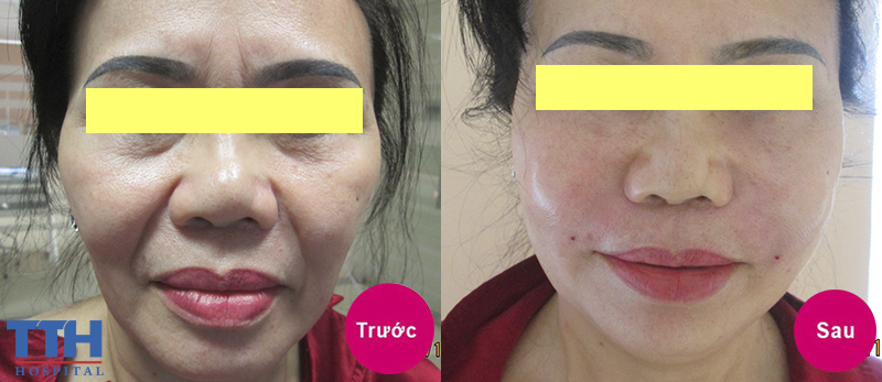 một khách hàng rất hài lòng sau khi thực hiên cấy mỡ baby face tại bệnh viện Thái Thượng Hoàng