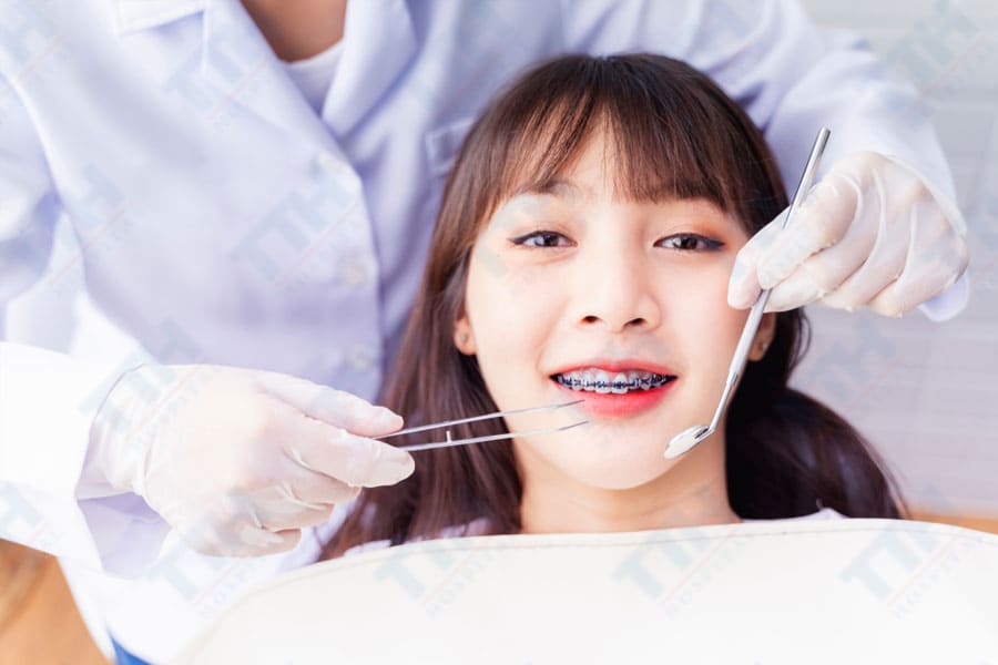 Các biện pháp bảo vệ răng trong quá trình niềng