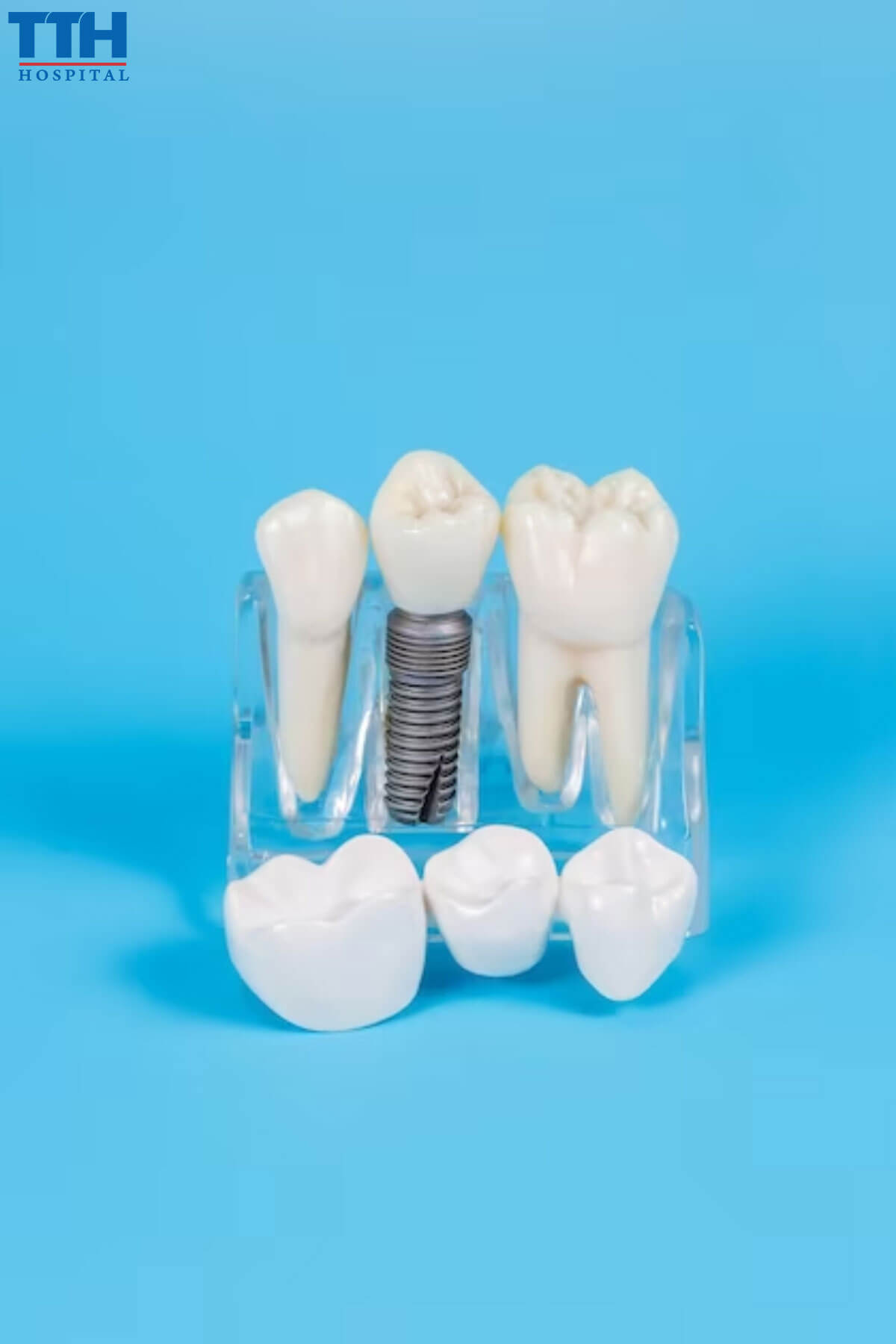 Các chất liệu tạo nên răng sứ tại vinh nghệ an