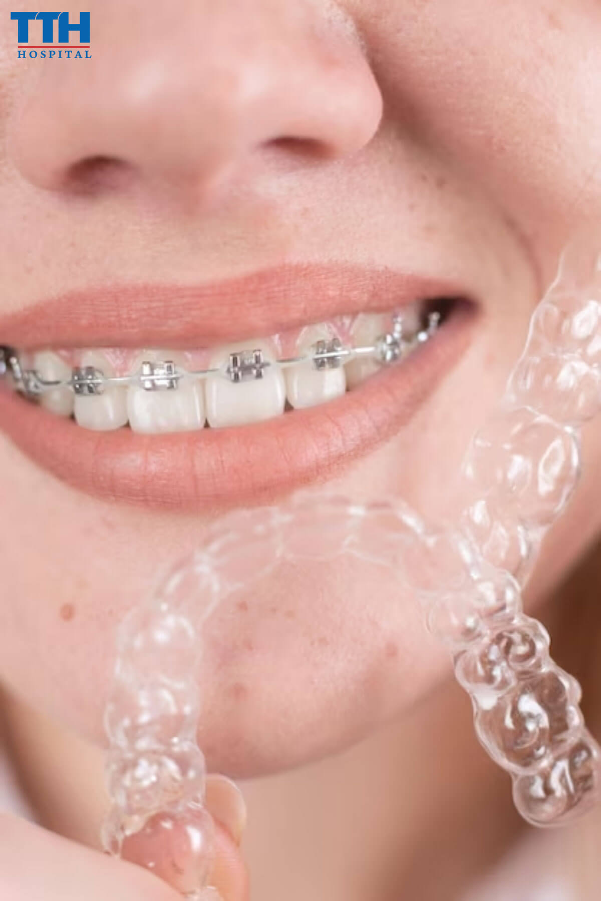 Các loại niềng răng phổ biến hiện nay