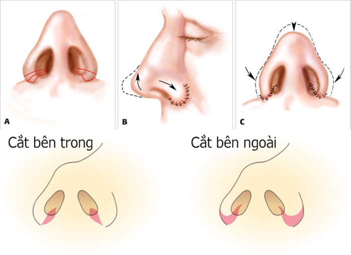 Thu gọn cánh mũi hiện có 2 kỹ thuật cơ bản