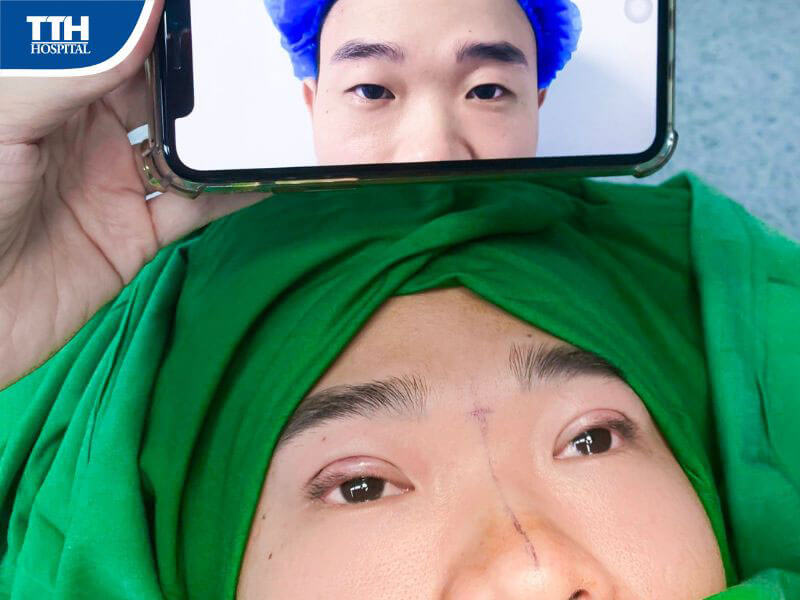 Cắt mí mắt là gì?