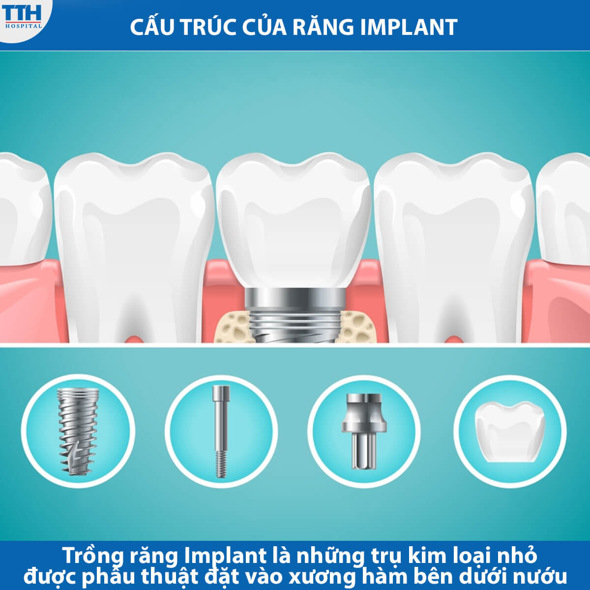 Cấu trúc của răng implant