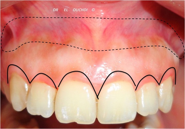 Quá trình chữa cười hở lợi chỉ diễn ra trong khoảng 40 phút