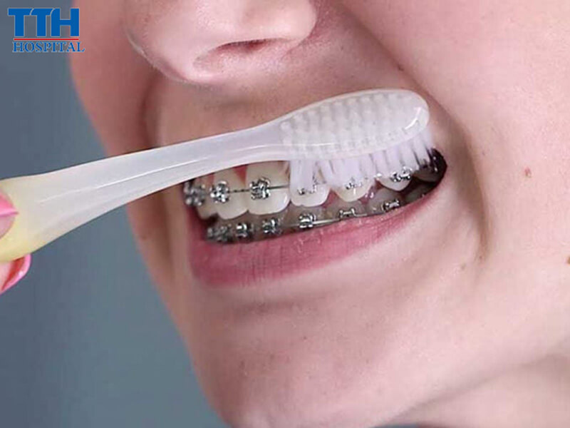 Chải Răng Đúng Cách – Không Chỉ Là Đủ, Mà Phải Đúng