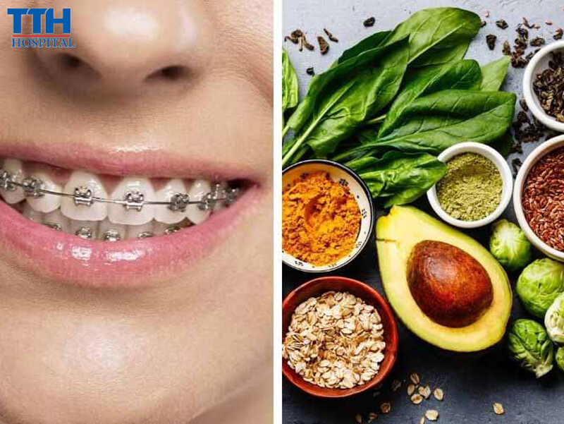 Chế Độ Ăn Uống Phù Hợp Khi Niềng Răng
