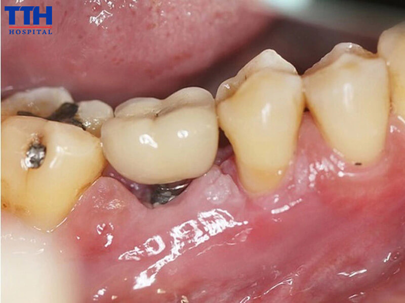 Chọn implant giá rẻ – rủi ro gì đang chờ đón?