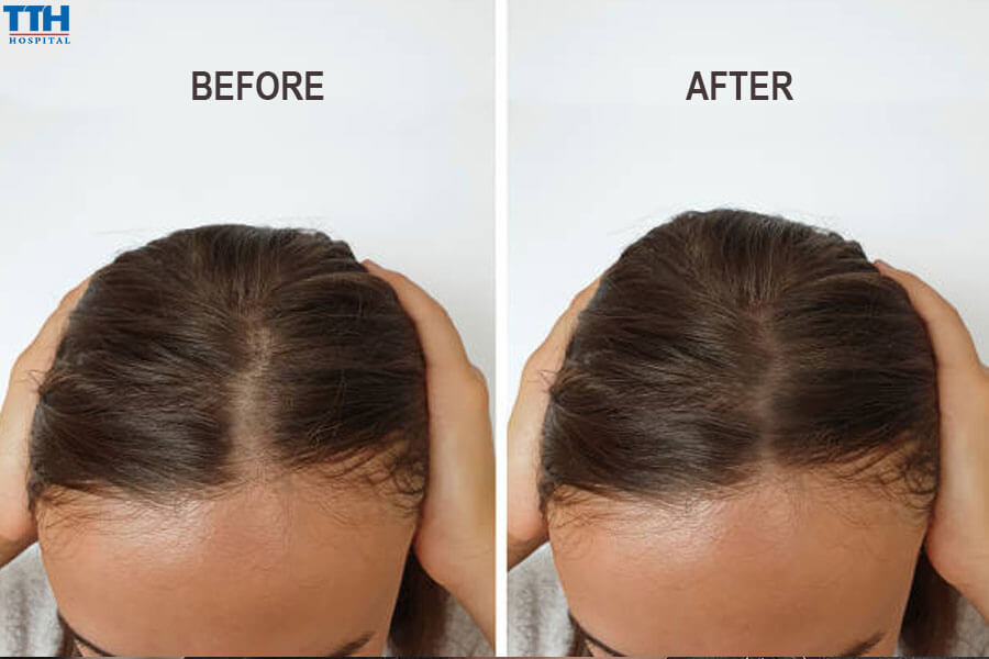 Cơ Chế Hoạt Động Của Mesotherapy