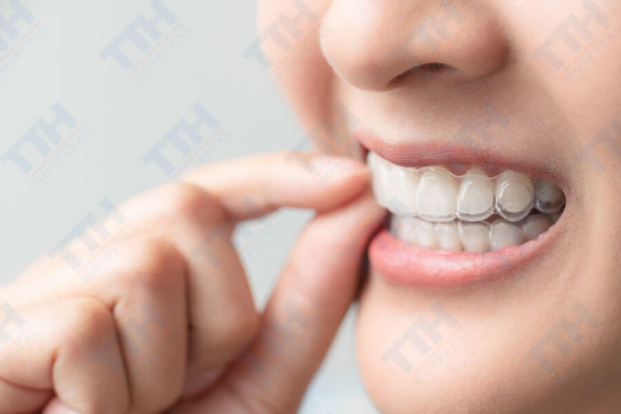 TTH Aligners là một hệ thống niềng răng trong suốt, sử dụng các khay niềng được thiết kế riêng cho từng người bệnh của bệnh viện Thái Thượng Hoàng.