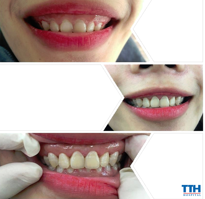 PHƯƠNG PHÁP THỰC HIỆN CHỮA CƯỜI HỞ LỢI