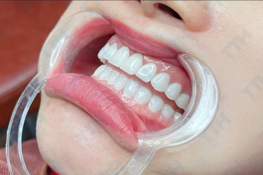 Đặc Tính Nổi Bật của High Translucent Zirconia