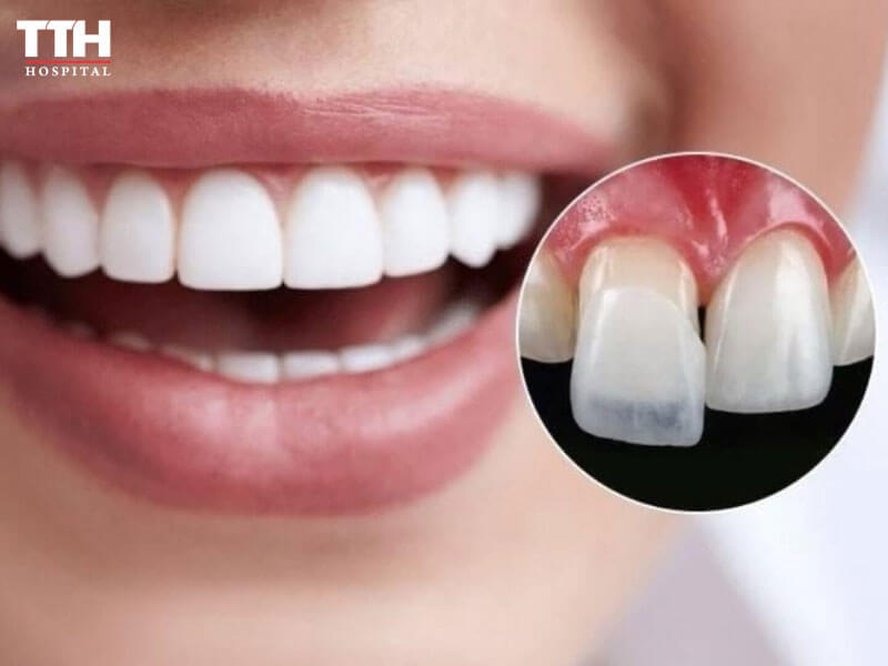 Dán sứ veneer là gì?
