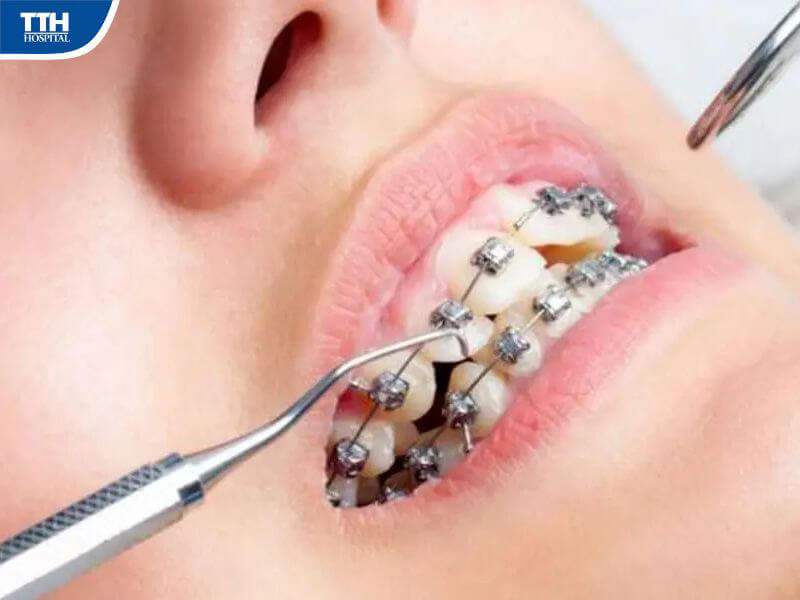 Khớp cắn ngược gây hậu quả gì?