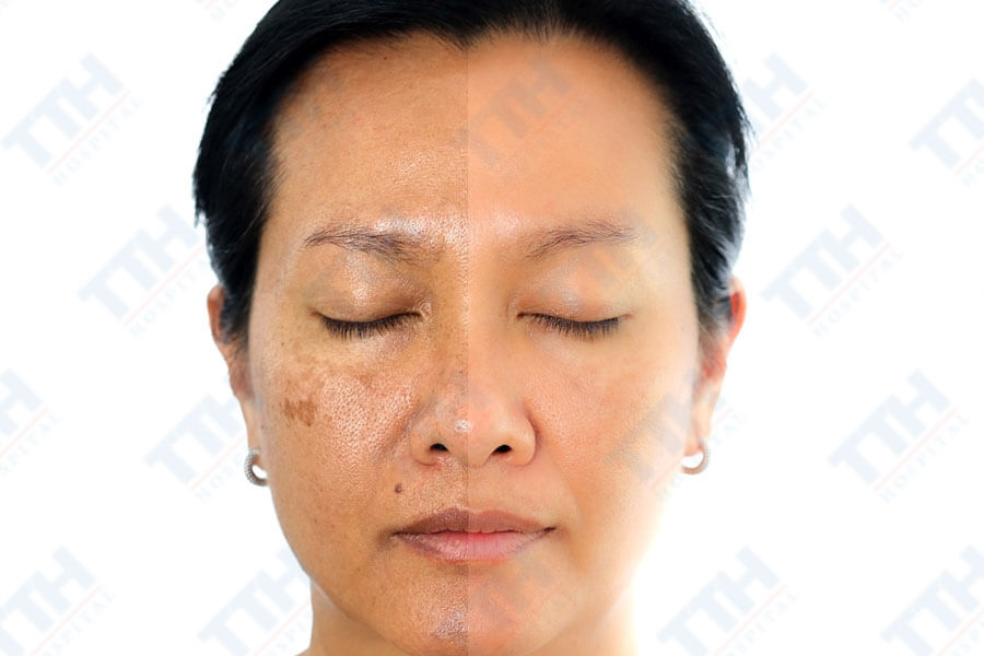 Điều trị nám cánh bướm