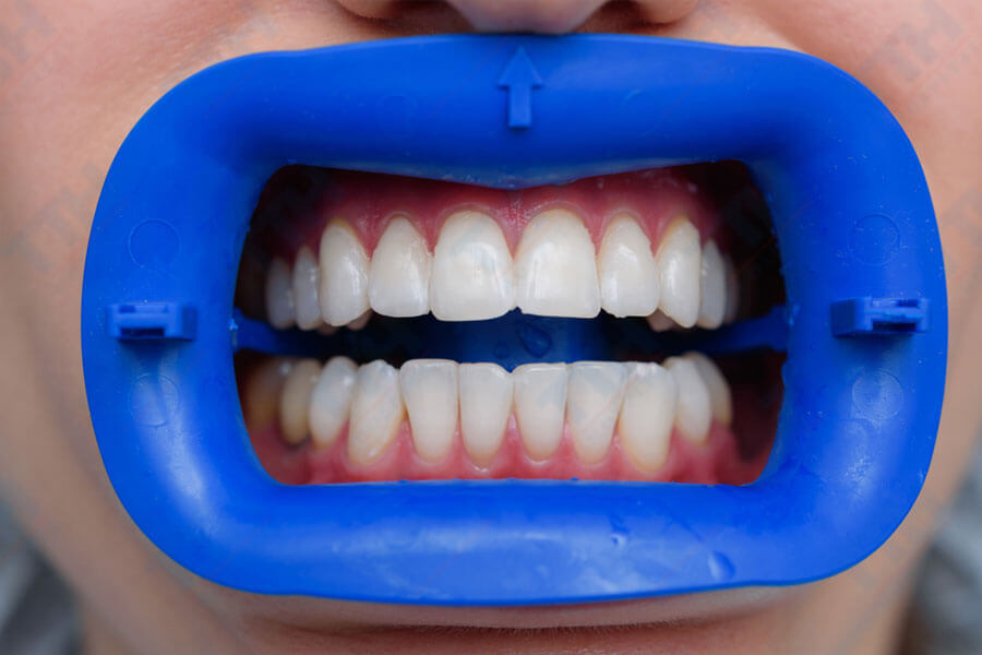 Độ bền lâu dài của răng sứ Zirconia