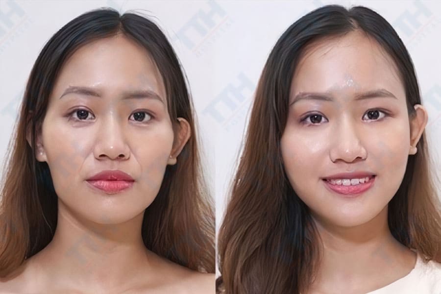 Độn thái dương là gì?