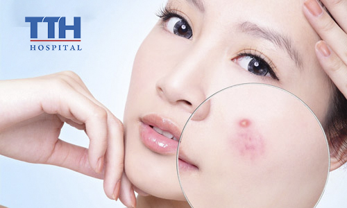 Điều trị mụn trứng cá