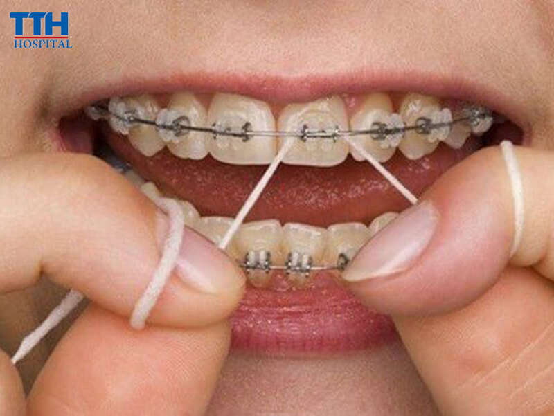 Dùng Chỉ Nha Khoa Có Đầu Luồn Hoặc Loại Chuyên Dụng Cho Người Niềng