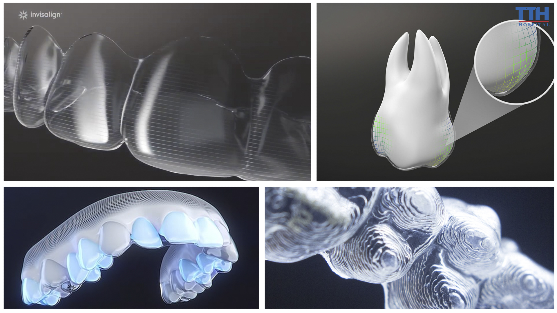 Khay niềng Invisalign được chế tác từ vật liệu SmartTrack giúp bác sĩ kiểm soát chặt chẽ và dễ dàng hơn sự dịch chuyển của răng trong từng giai đoạn