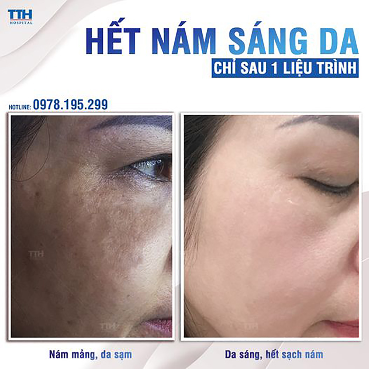 Hết nám sáng da chỉ sau 1 liệu trình