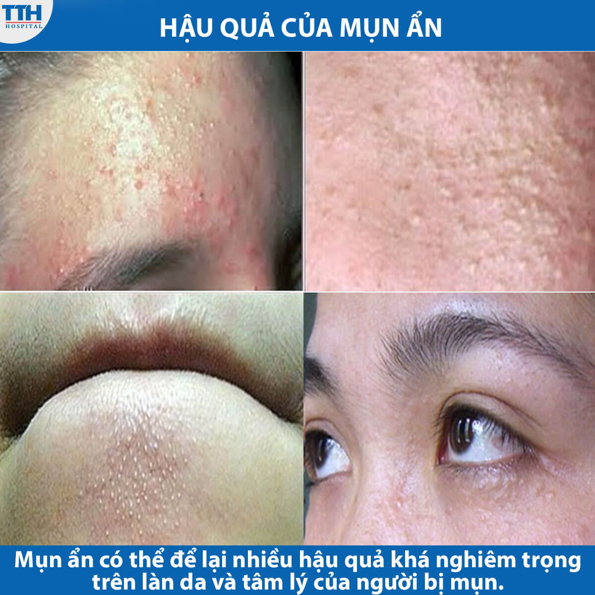 hậu quả của mụn ẩn