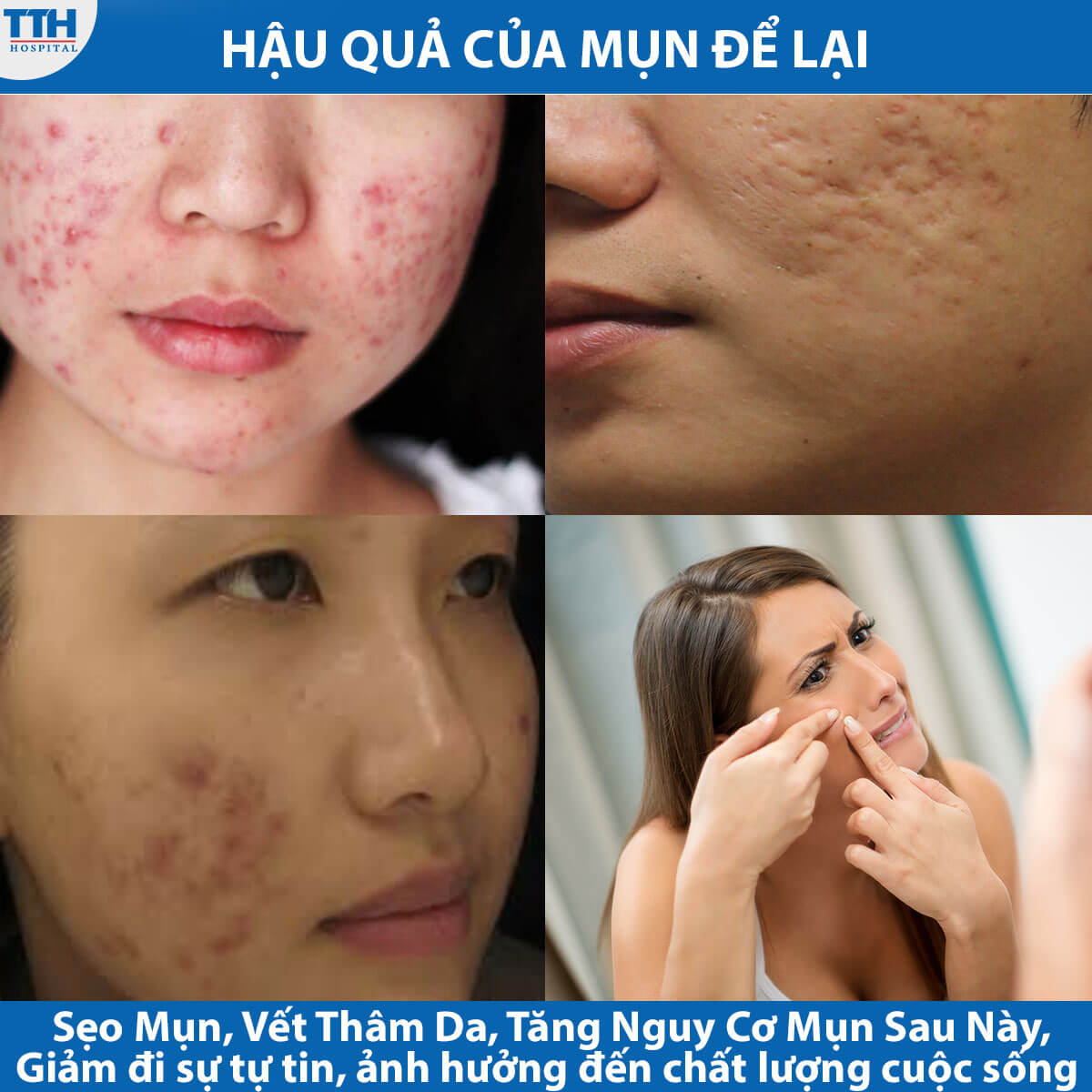Hậu quả của mụn để lại