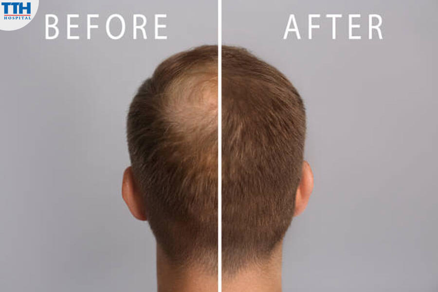 Những Điều Cần Lưu Ý Khi Thực Hiện Mesotherapy