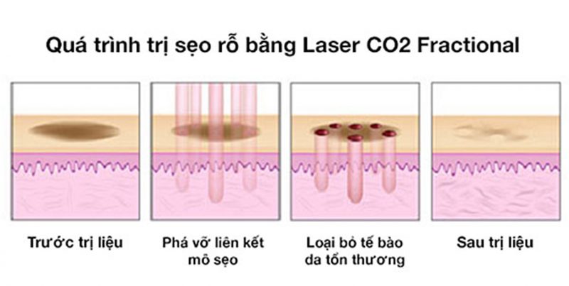 Hiệu quả điều trị sẹo