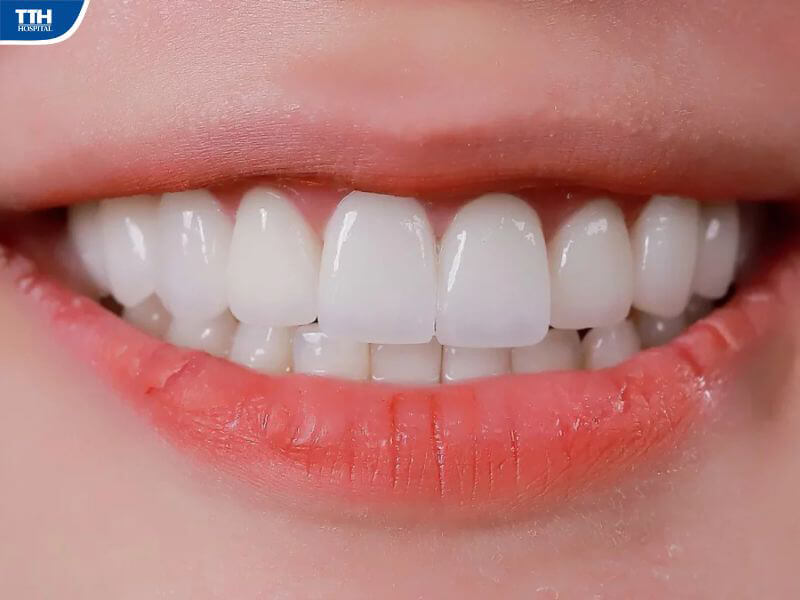 Hướng dẫn chăm sóc răng sau khi dán sứ