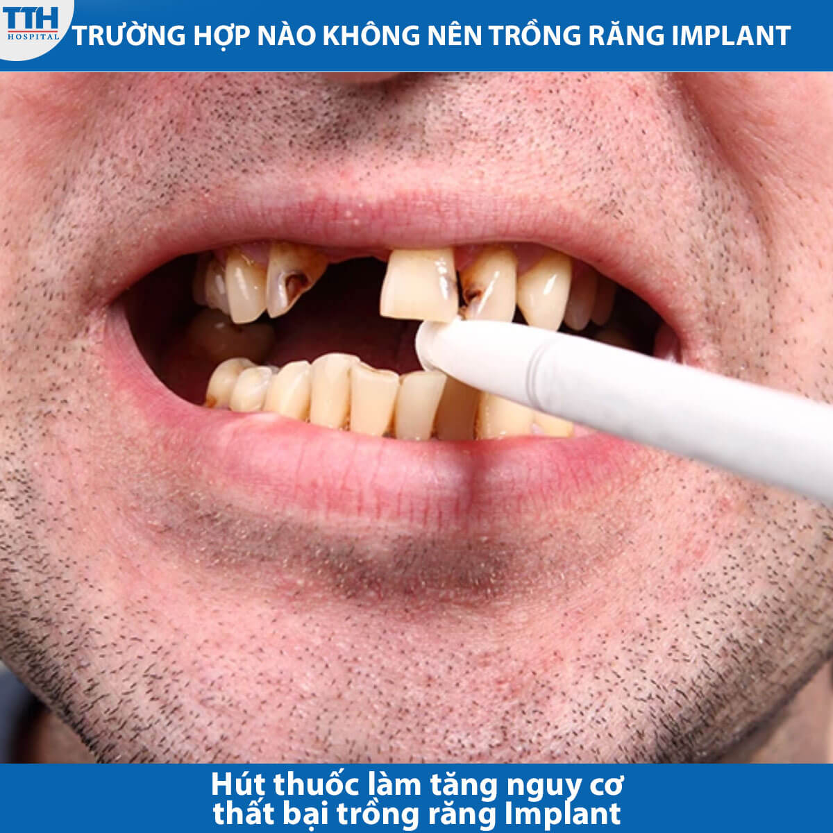  Ai không phù hợp với trồng răng implant?