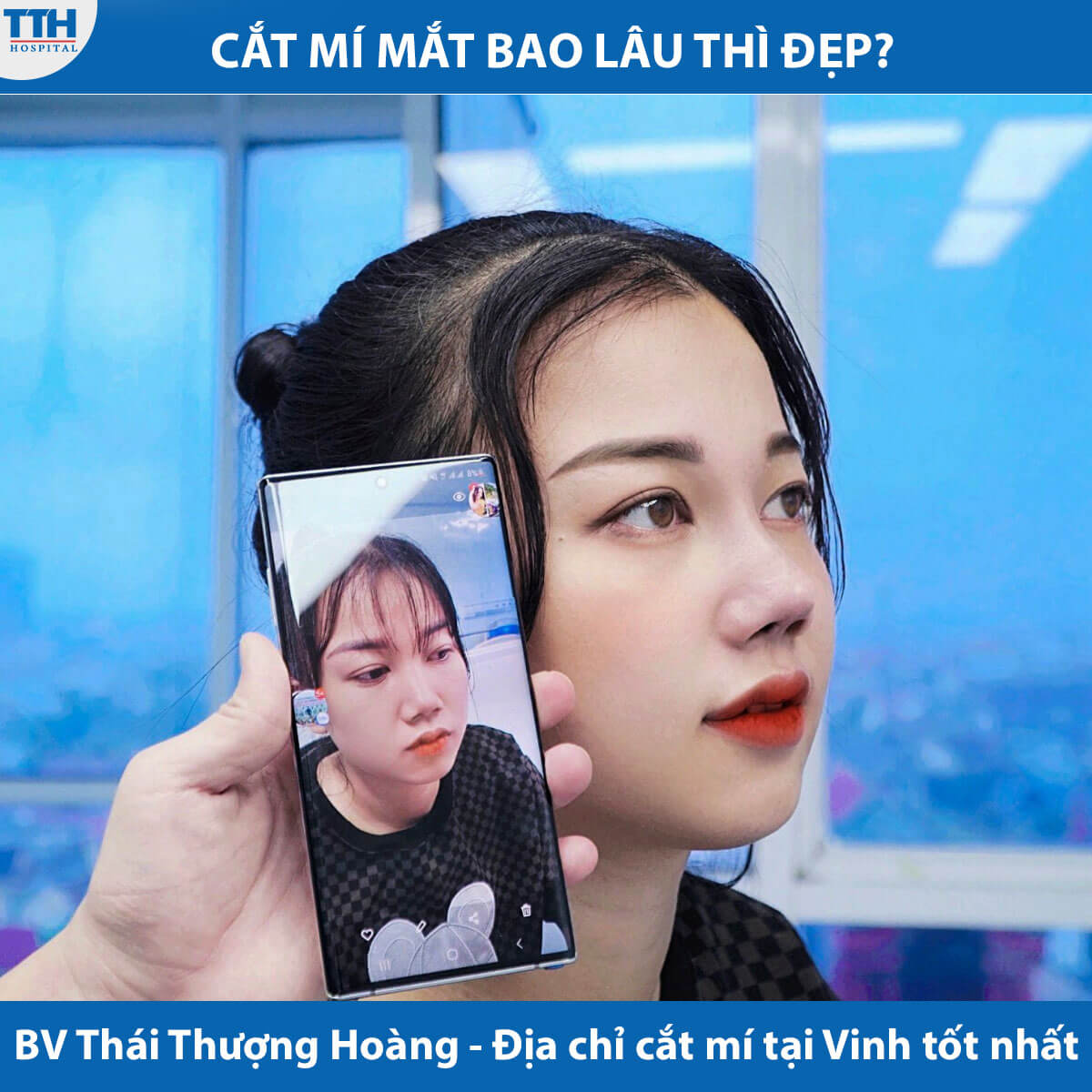 Khách hàng thực hiện cắt mí tại bệnh viện Thái Thượng Hoàng