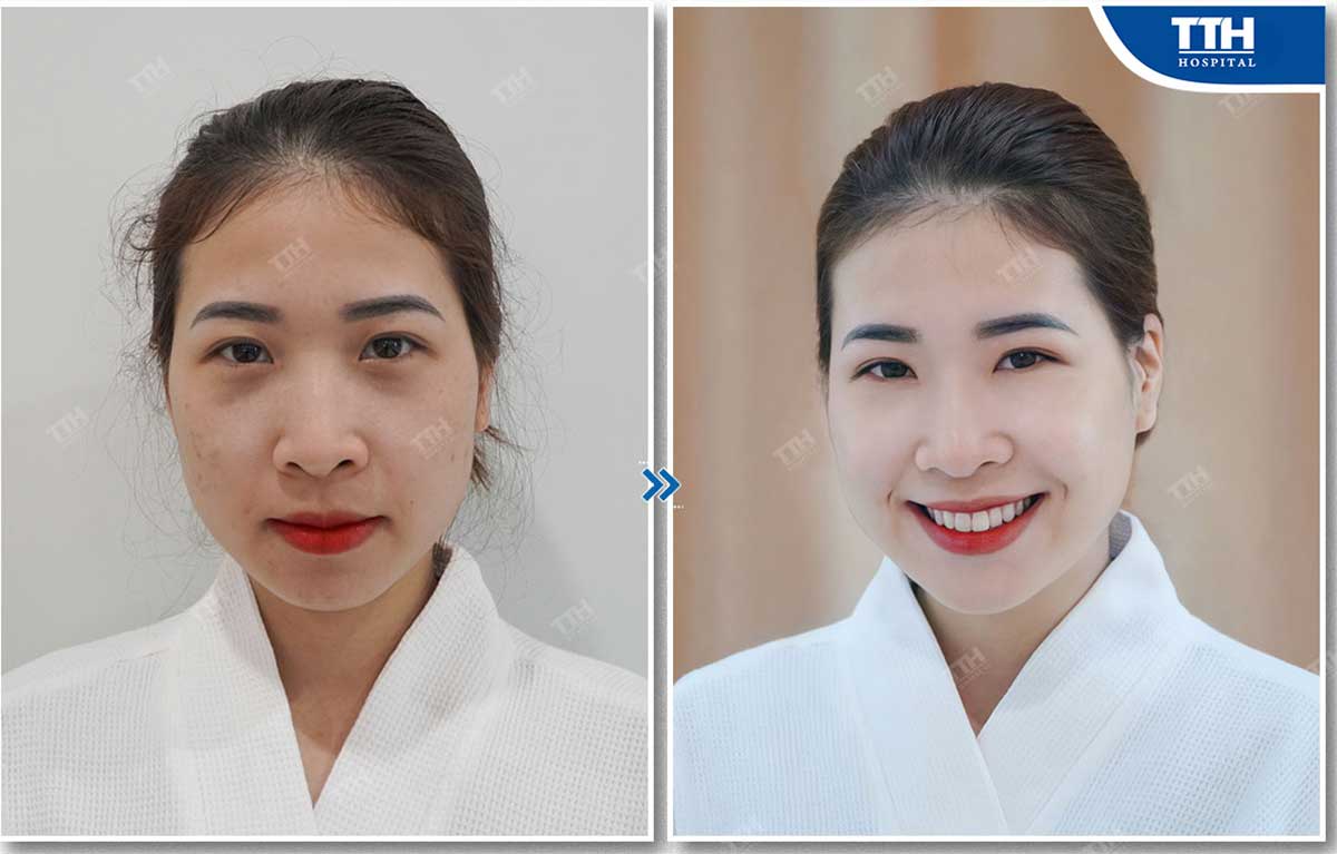 Hình ảnh khách hàng trước và sau khi sử dụng dịch vụ tại bệnh viện Thái Thượng Hoàng