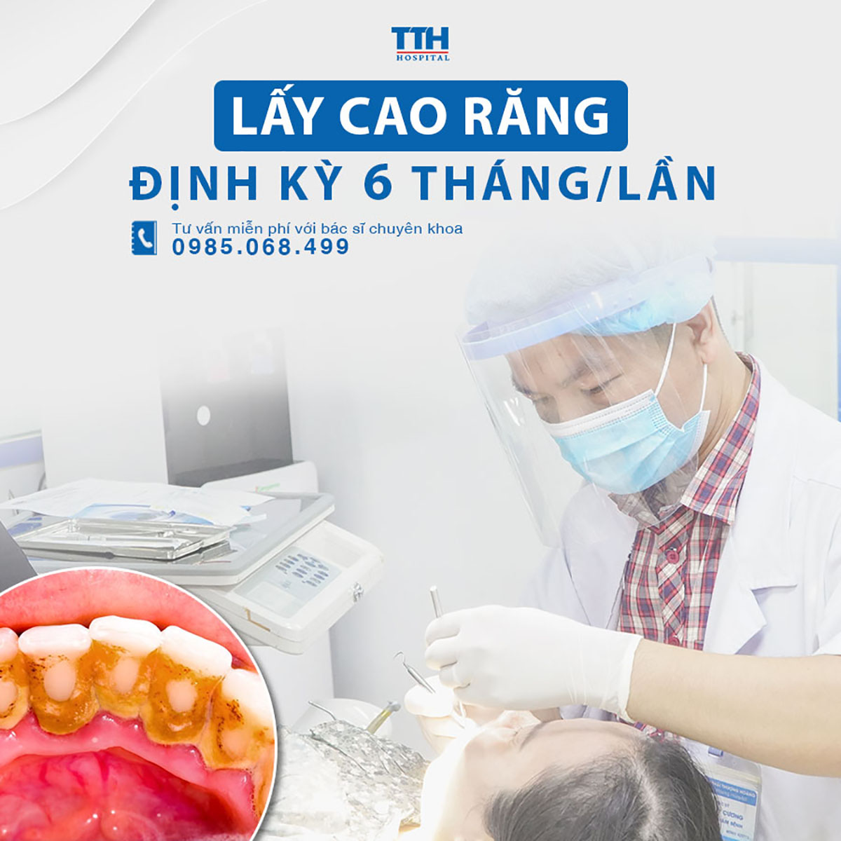Lấy cao răng định kỳ 6 tháng/1 lần