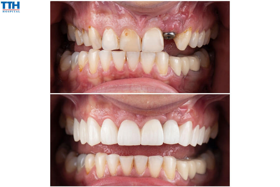 Trồng răng implant có đau không