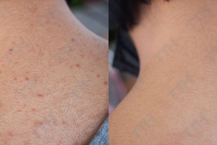 Lưu ý khi thực hiện điều trị mụn lưng bằng IPL kết hợp Oxy Jet aqua peel