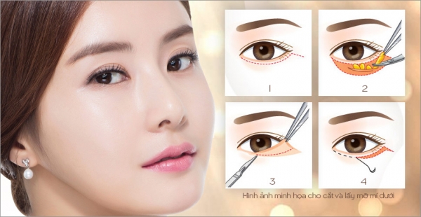 Cắt da thừa, lấy mỡ mí mắt
