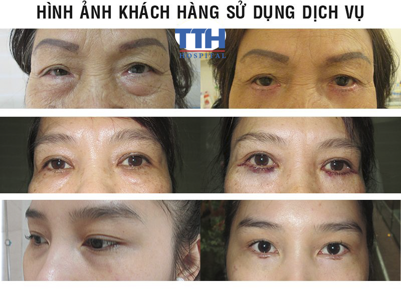 Bác sỹ thăm khám xem xét cấu trúc, đặc điểm mí mắt và tư vấn cho khách hàng phương pháp thẩm mỹ phù hợp