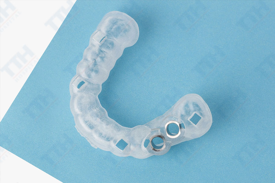 Máng (Guide) hướng dẫn phẫu thuật implant là gì?