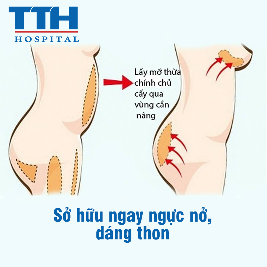 Mỡ tự thân là phương pháp hút mỡ trên chính cơ thể của bạn