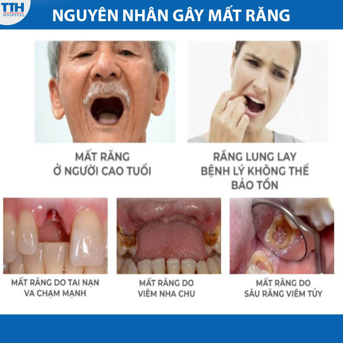 Nguyên nhân gây mất răng