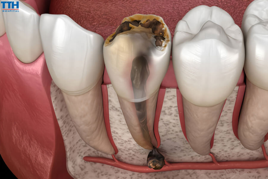 Nguyên Nhân Gây Ra Áp Xe Tủy Răng