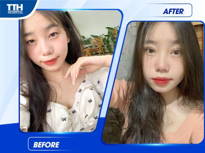 Những điều cần lưu ý sau khi cắt mí mắt