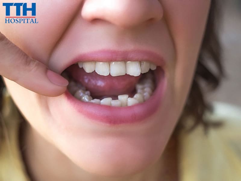 Những trường hợp nào nên cân nhắc niềng răng ở tuổi trưởng thành?