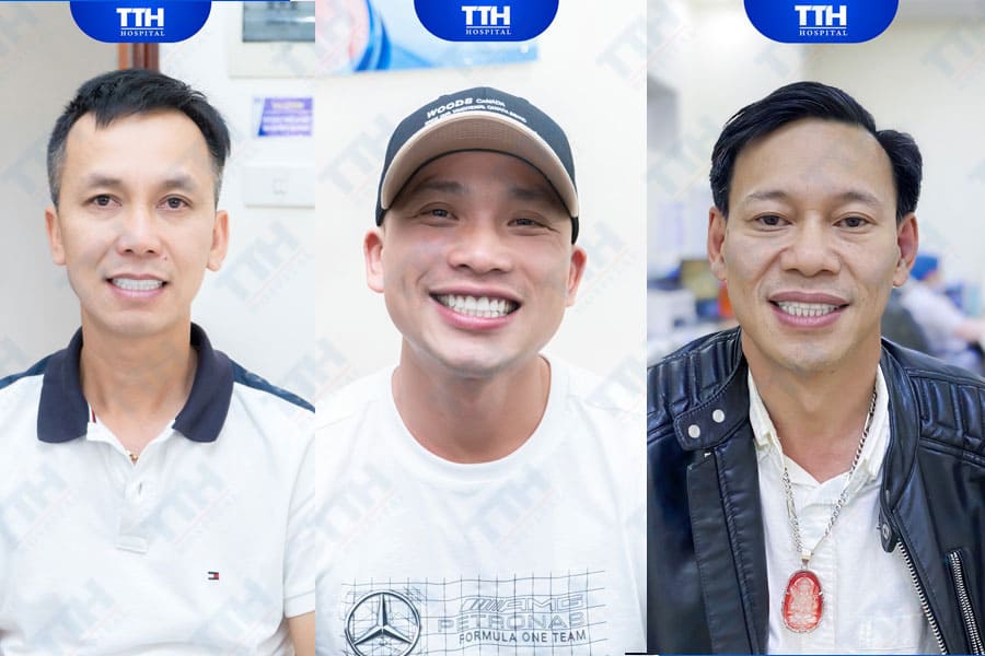 Vì sao bạn nên chọn thẩm mỹ răng sứ?
