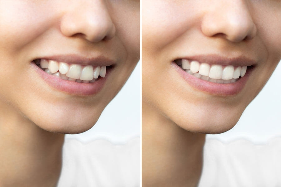 Những yếu tố ảnh hưởng đến việc hóp má khi niềng răng
