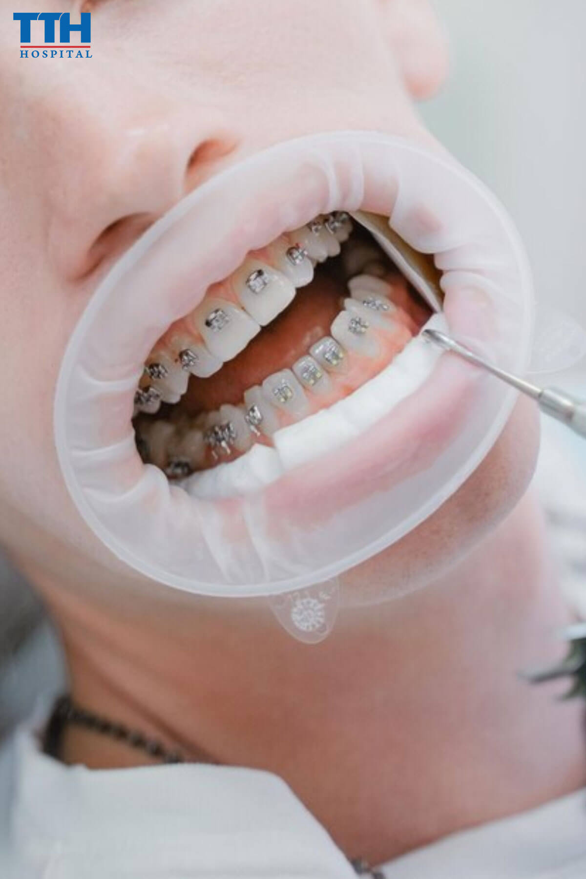 Niềng răng là gì? Niềng răng tại vinh nghệ an